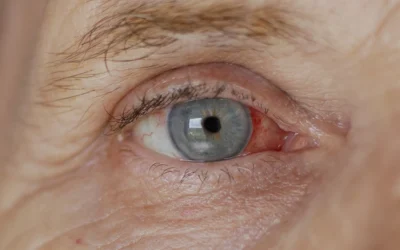 Does Diabetes Cause Cataracts? What You Need to Know