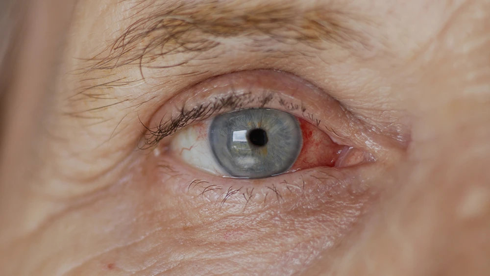 Does Diabetes Cause Cataracts? What You Need to Know