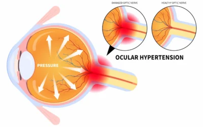 What Is Ocular Hypertension, and Does It Always Lead to Glaucoma?